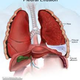 Illustration for article titled Penyakit Paru Paru Tuberkulosisem/em